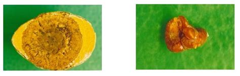 Ilustrácia rôznych typov močových kameňov