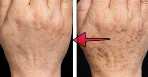 Detail fotografie tmavnutia kože na rukách a ďasnách ako príznak hyperpigmentácie