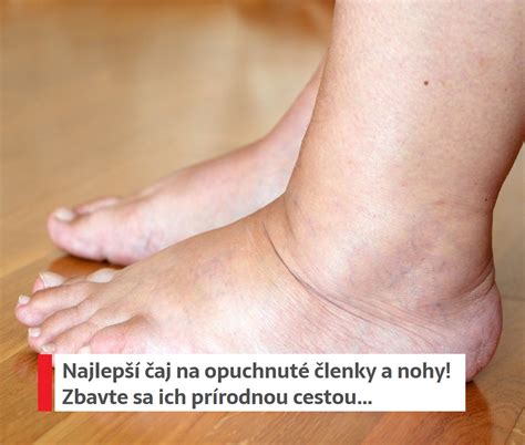 Ilustrácia opuchnutých členkov