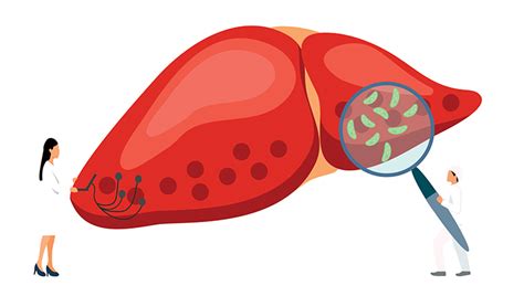Schéma pečene s vyznačenými poškodeniami v dôsledku alkoholu