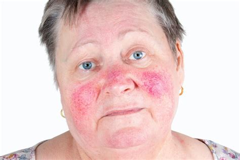 červené fľaky na tvári po alkohole