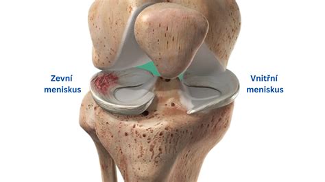 Ilustrácia konkávneho a konvexného menisku