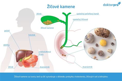 Diagram žlčníka so žlčovými kameňmi