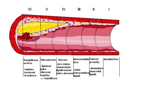Schematické znázornenie aterosklerotického plátu v tepne