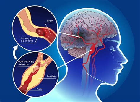 Infografika zobrazujúca štruktúru mozgu a vplyv alkoholu na neuróny