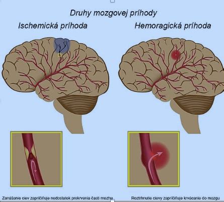 Infografika zobrazujúca rozdelenie mozgovej príhody na ischemickú a hemoragickú