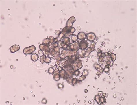 Ilustrácia kryštálov kyseliny močovej v kĺbe