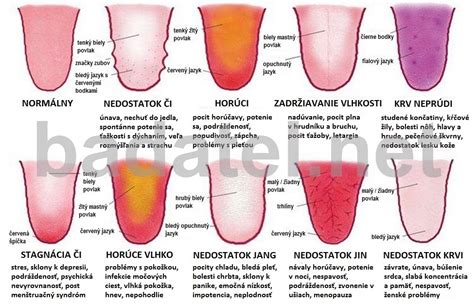 Diagram znázorňujúci rôzne príčiny pálenia jazyka
