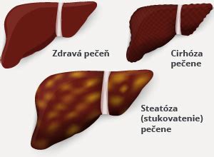 Grafické znázornenie postupných štádií alkoholového ochorenia pečene