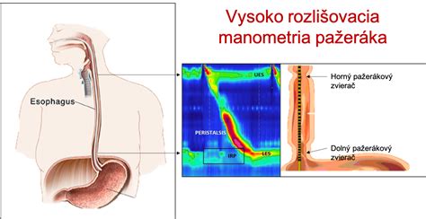 Diagram dolného pažerákového zvierača