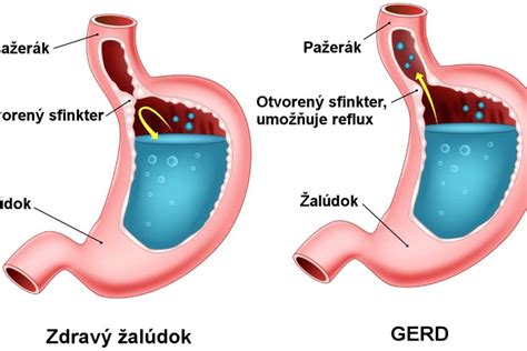 Štruktúra žalúdka a pažeráka
