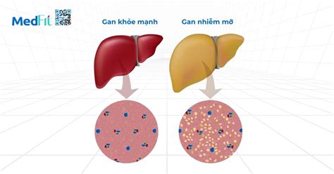 Infografika znázorňujúca pečeň a jej funkcie, s vyznačeným miestom metabolizácie liekov a alkoholu.