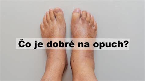 Ilustrácia opuchnutých nôh a členkov