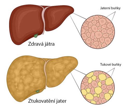 Diagram zobrazujúci vplyv alkoholu na funkciu pečene pri tvorbe glukózy
