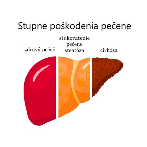 Diagram znázorňujúci poškodenie pečene alkoholom