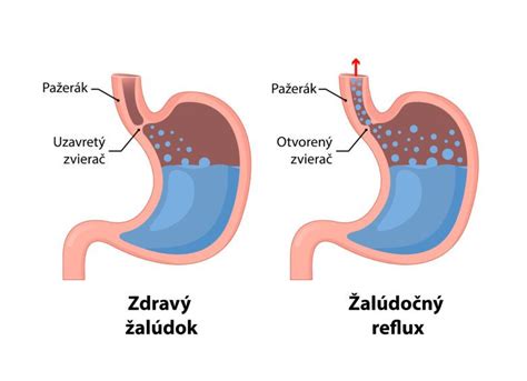Anatomické usporiadanie pažeráka a žalúdka s vyznačeným dolným pažerákovým zvieračom