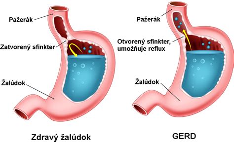 Infografika zobrazujúca bežné príznaky refluxu pažeráka