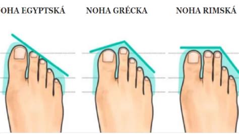 Ilustrácia kĺbu prsta na nohe postihnutého dnou