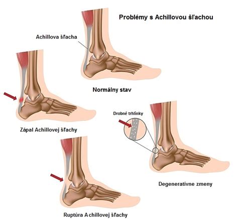 Grafické znázornenie rozhodovania o liečbe ruptúry Achillovej šľachy
