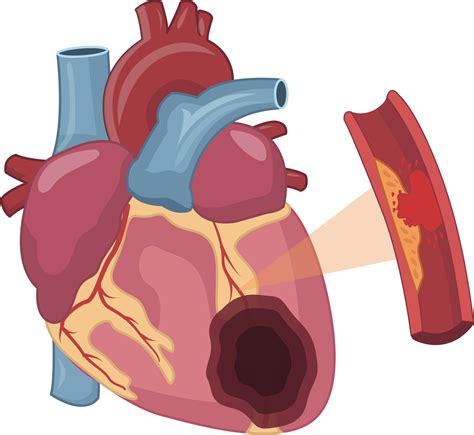Symbol srdca s prerušenou čiarou, symbolizujúci poškodenie srdca alkoholom
