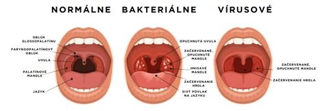 Ilustrácia ľudského hrdla s vyznačenými mandľami a hltanom