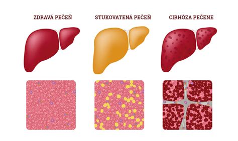 Symbolické znázornenie poškodenia pečene alkoholom